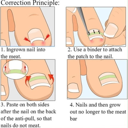 Ingrown foe nails correction kit