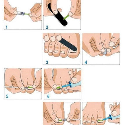 Ingrown foe nails correction kit