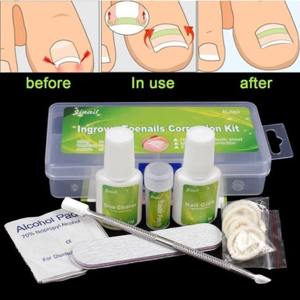 Ingrown foe nails correction kit